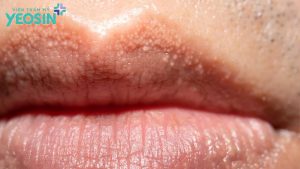 môi bị hạt fordyce có phun môi được không