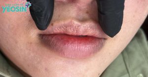 ĐỐM TRẮNG TRÊN MÔI