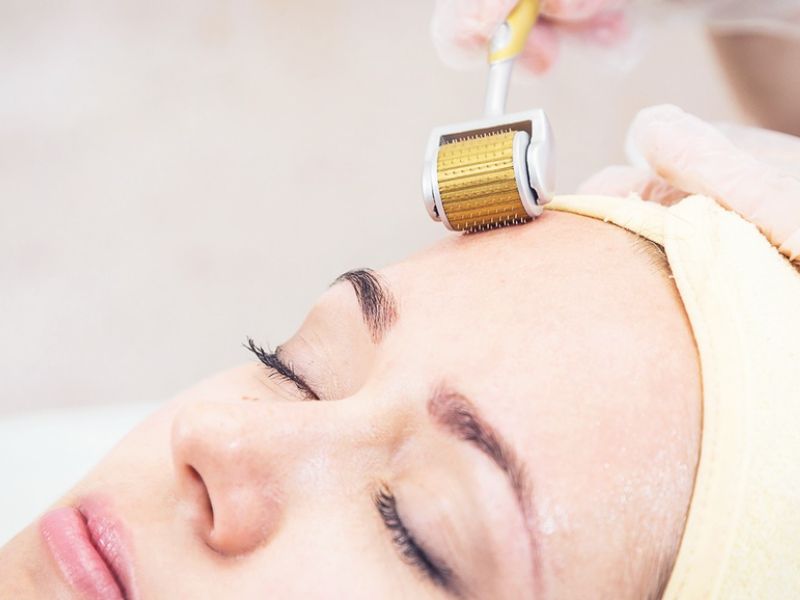 liệu trình lăn kim trị mụn giá bao nhiêu