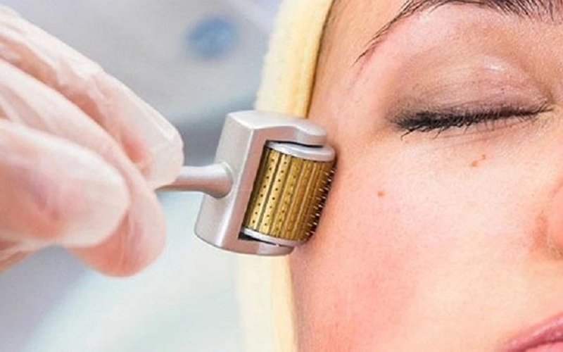 liệu trình lăn kim trị mụn giá bao nhiêu