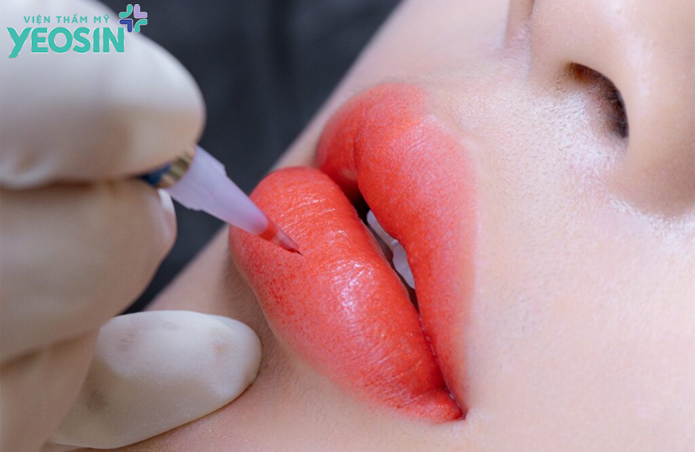 môi bị hạt fordyce có phun môi được không?