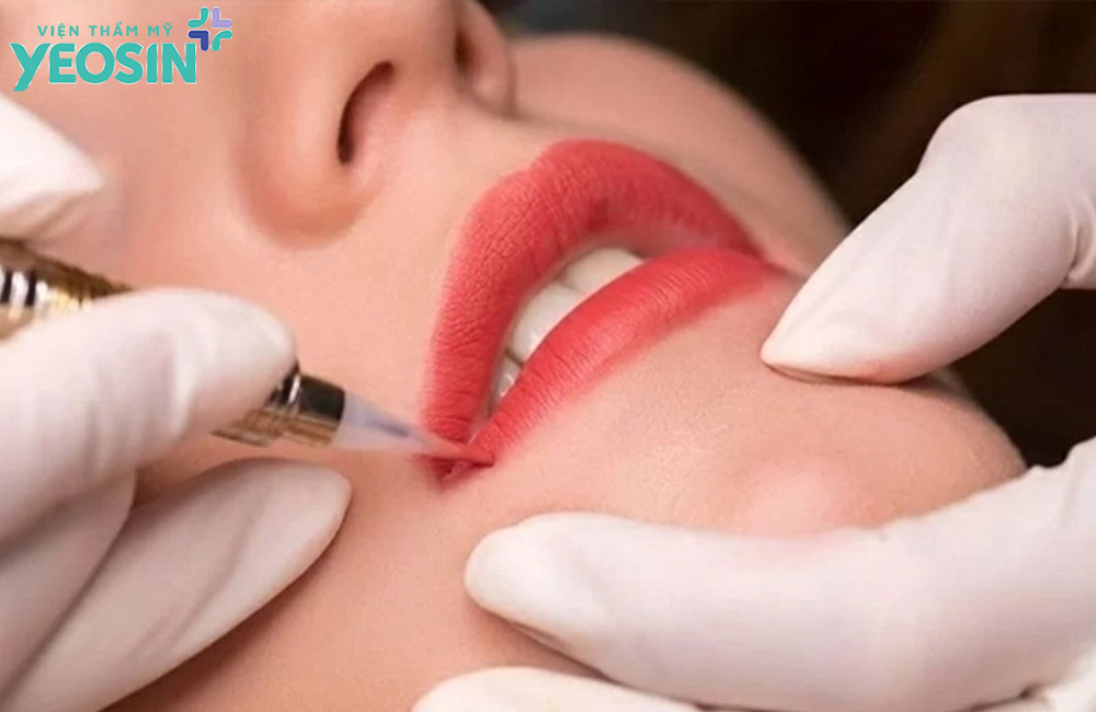 Quy trình phun môi cho người bị hạt fordyce ở môi