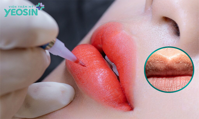 Môi bị hạt fordyce có phun môi được không?