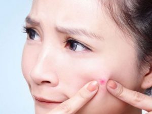 mụn nặn ra có mùi hôi