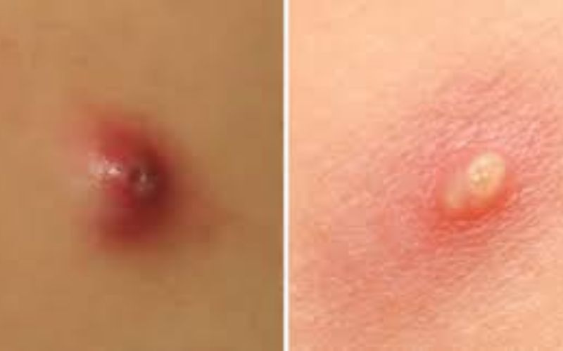 Mụn nhọt ở nách: Nguyên nhân, cách chữa và phòng ngừa hiệu quả 4 mụn nhọt ở nách