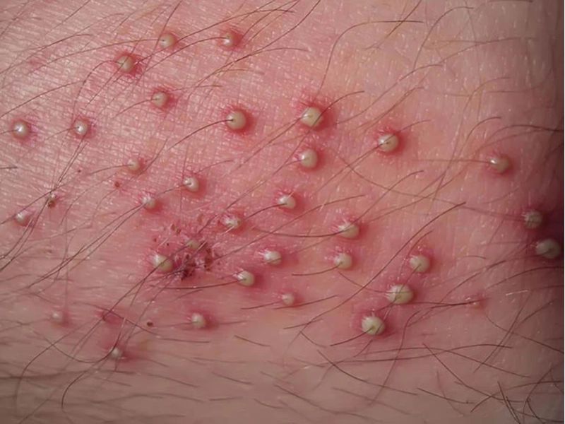 Mụn nhọt ở nách: Nguyên nhân, cách chữa và phòng ngừa hiệu quả 5 mụn nhọt ở nách