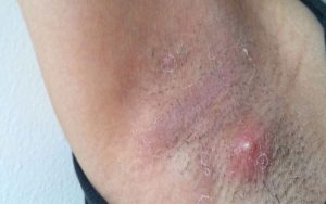 mụn nhọt ở nách