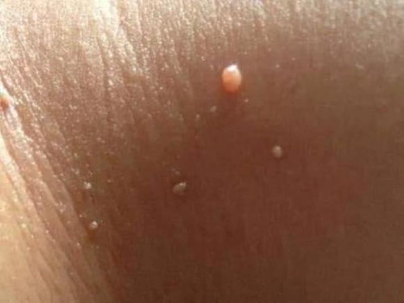 mụn thịt ở nách