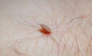 mụn thịt ở nách