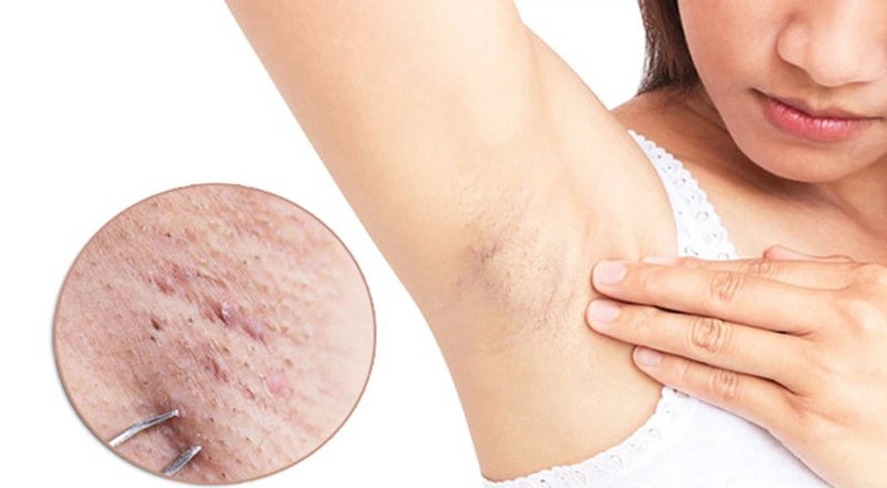 mụn thịt ở nách