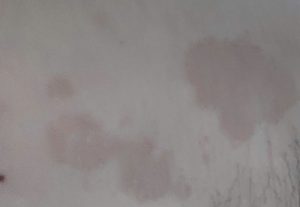 nách bị đốm nâu