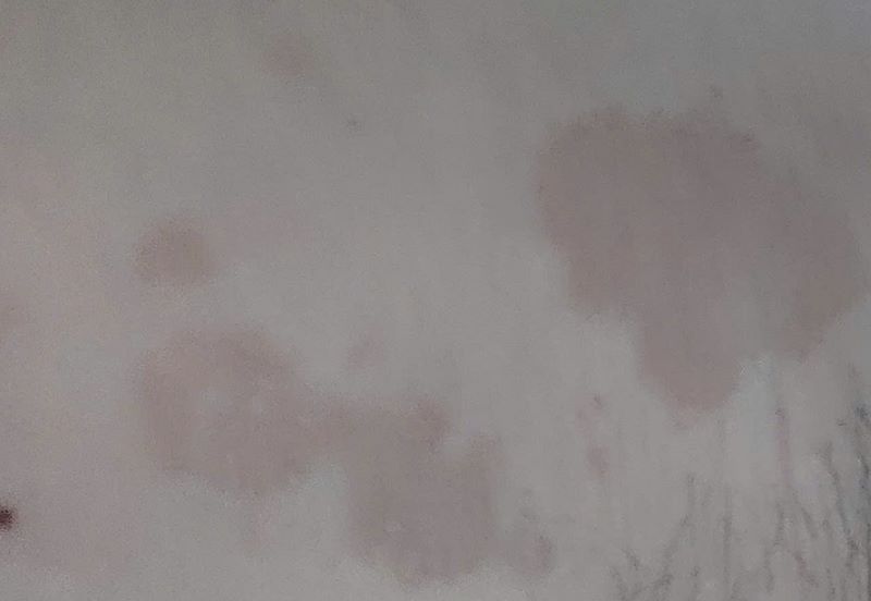 nách bị đốm nâu