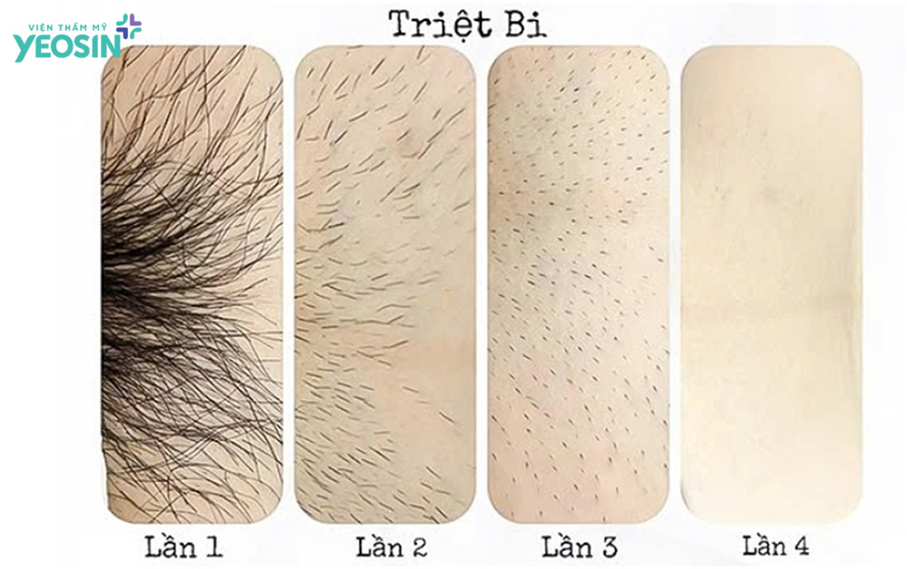Sau khi triệt lông bikini lần đầu bao lâu thì đi triệt lại?