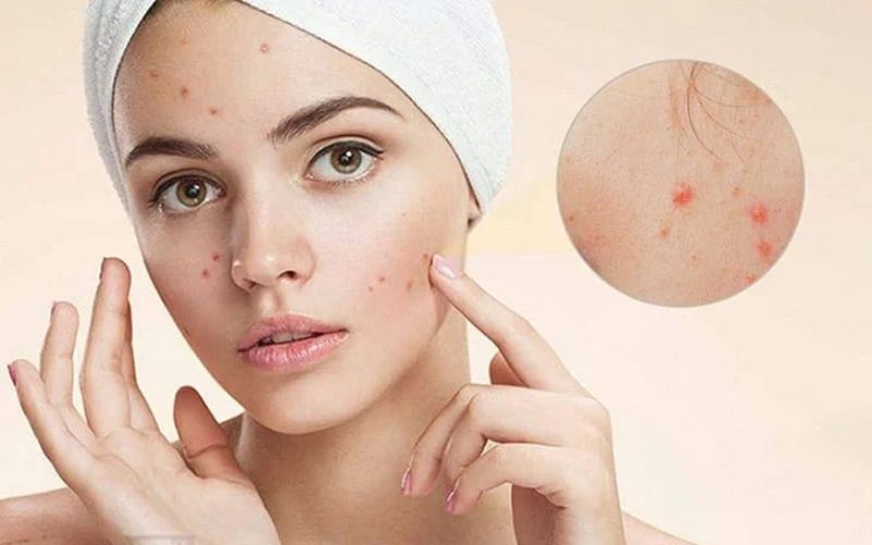 trị mụn bằng laser giá bao nhiêu