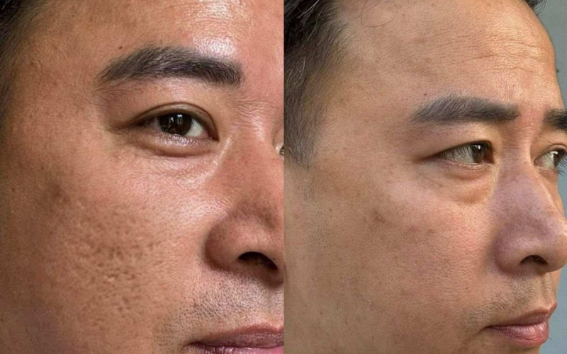 Trị sẹo lõm bao nhiêu tiền? Bảng giá mới nhất và những điều cần biết 6 trị sẹo lõm bao nhiêu tiền