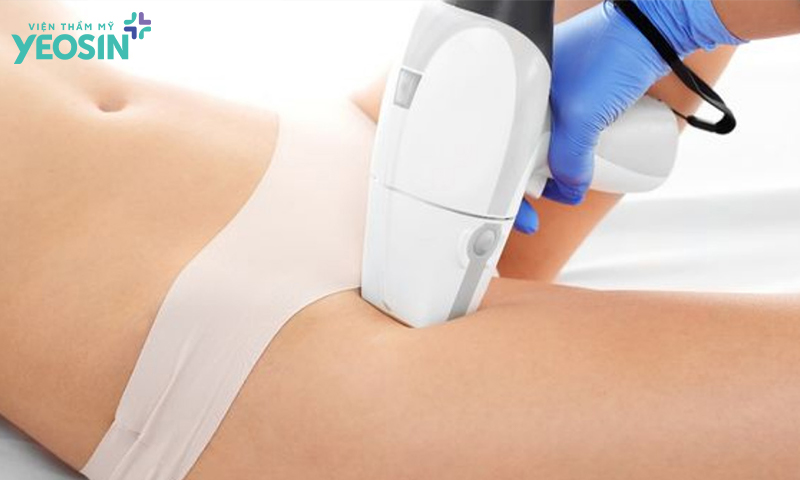 Triệt lông bikini có xui không?