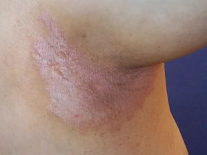 viêm da dị ứng ở nách