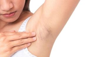 viêm nang lông nách