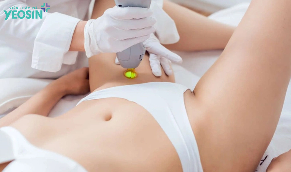 Những lưu ý quan trọng cho thắc mắc triệt lông bikini có xui không