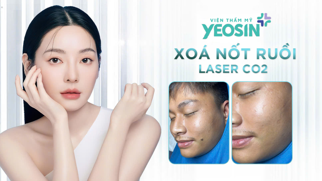 Tẩy nốt ruồi bằng laser CO2
