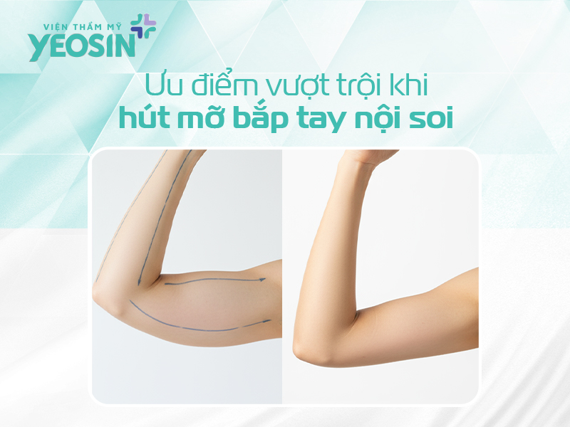 Hút mỡ bắp tay - Loại bỏ mỡ thừa cánh tay nhanh và an toàn 12 Ưu điểm vượt trội khi hút mỡ bắp tay nội soi