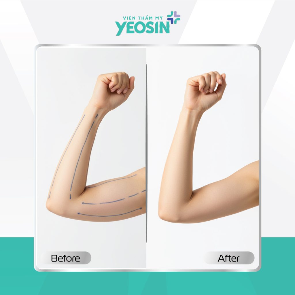 Hình ảnh trước và sau khi hút mỡ bắp tay tại Viện Thẩm Mỹ Yeosin