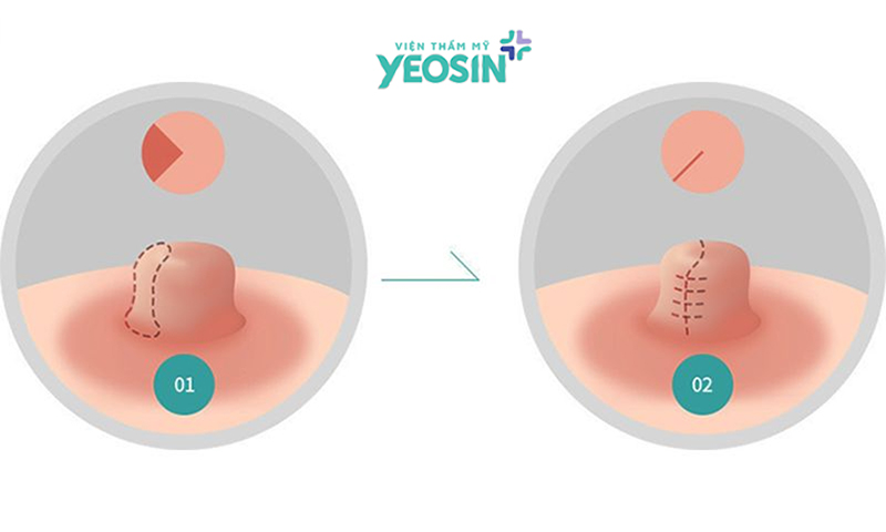 Bảng giá thu nhỏ nhũ hoa mới nhất hiện nay 4 Giá thu nhỏ nhũ hoa bao nhiêu tiền là hợp lý?
