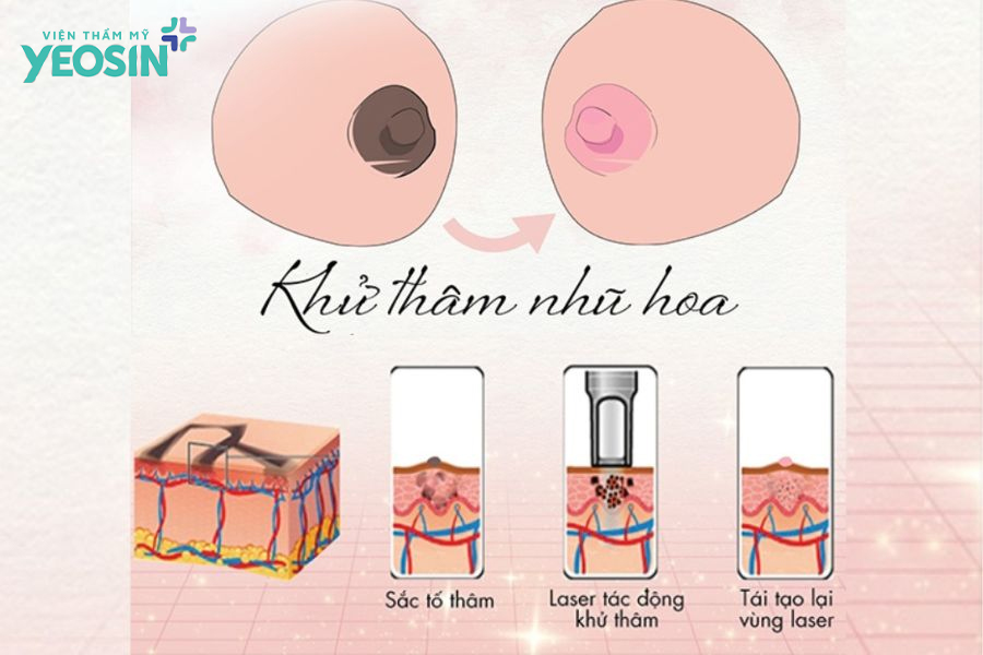 Có nên làm hồng nhũ hoa bằng laser không? Giá bao nhiêu? 5 Làm hồng nhũ hoa bằng laser là gì?