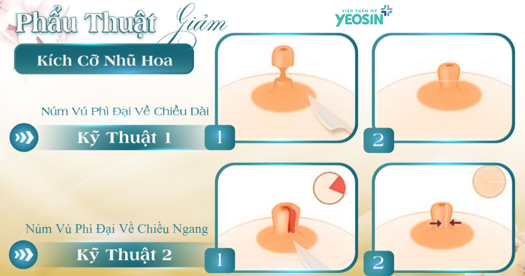 Bảng giá thu nhỏ nhũ hoa mới nhất hiện nay 5 Giá thu nhỏ nhũ hoa sẽ chịu ảnh hưởng bởi phương pháp sử dụng