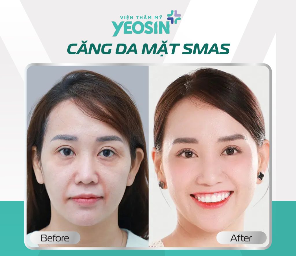 Căng da mặt trẻ hóa da Smas 15 1 1