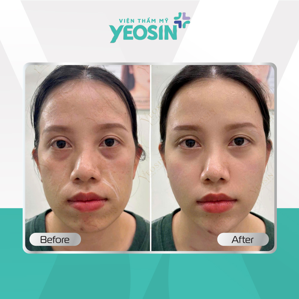 Nâng cơ trẻ hóa Hifu Doublo 2025 - Chìa khóa giữ mãi nét xuân 29 1