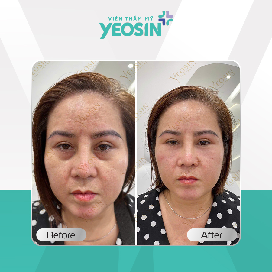 Hình ảnh trước và sau khi lấy mỡ thừa mí mắt trên dưới