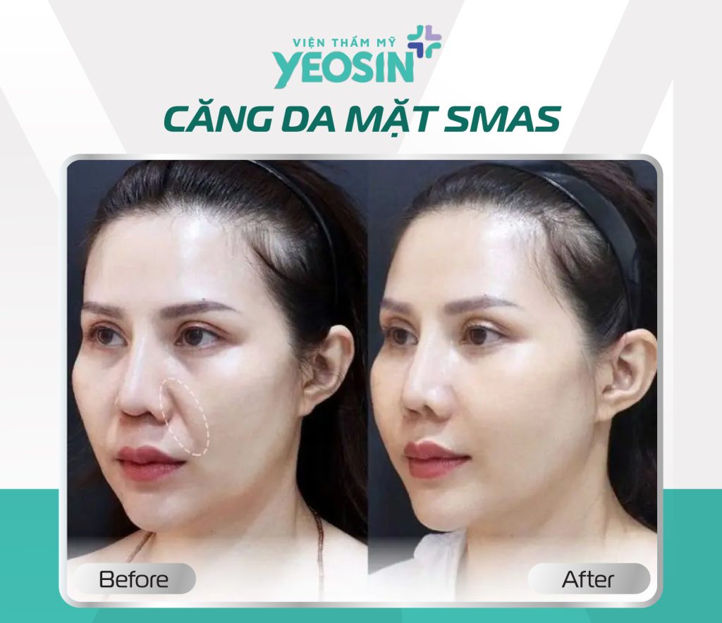 Căng da mặt trẻ hóa da Smas 17 3 1