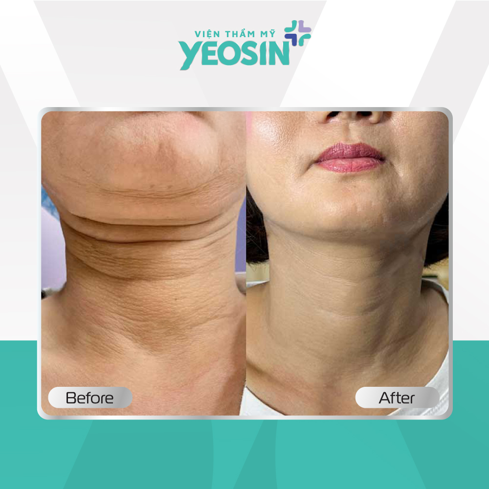 Căng da cổ 14 Hình ảnh trước và sau khi căng da cổ tại Viện Thẩm Mỹ Yeosin