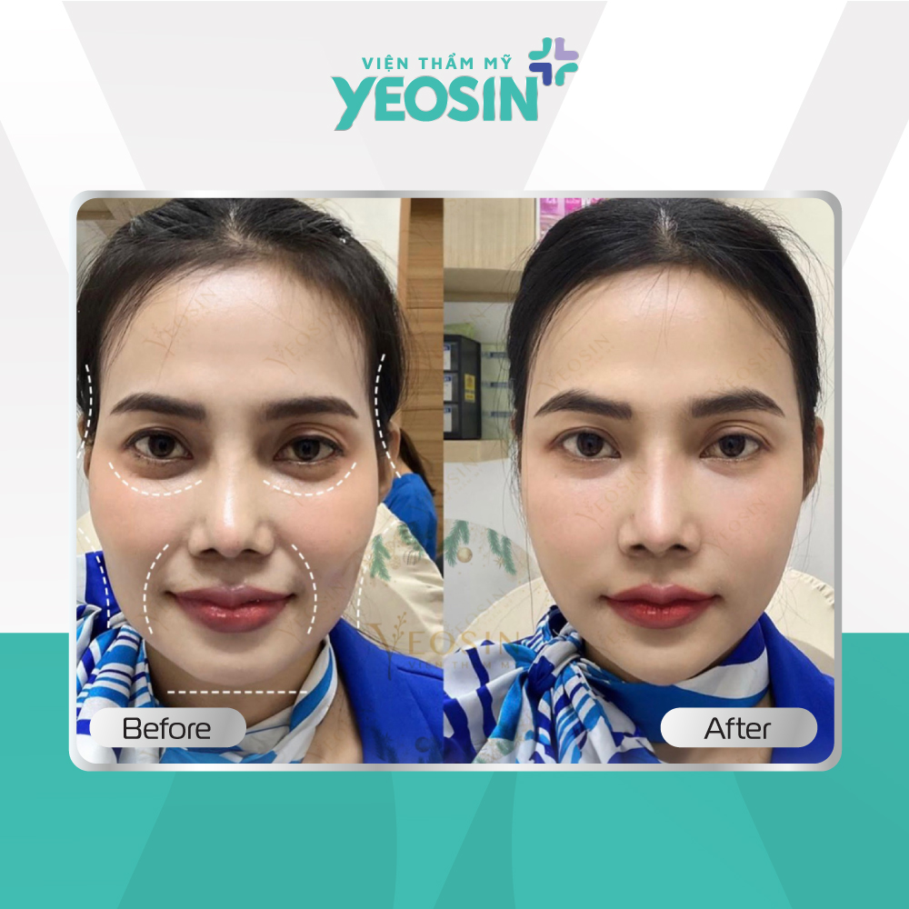 Nâng cơ trẻ hóa Hifu Doublo 2025 - Chìa khóa giữ mãi nét xuân 26 Hình ảnh trước và sau khi nâng cơ tại Viện Thẩm Mỹ Yeosin