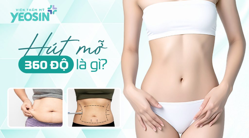 Hút mỡ 360 độ là gì?