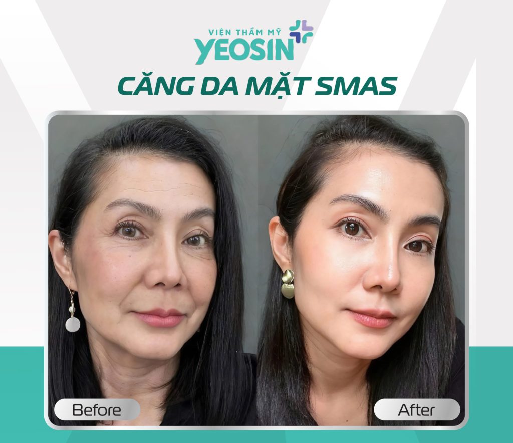 Hình ảnh trước và sau khi căng da mặt tại Viện Thẩm Mỹ Yeosin