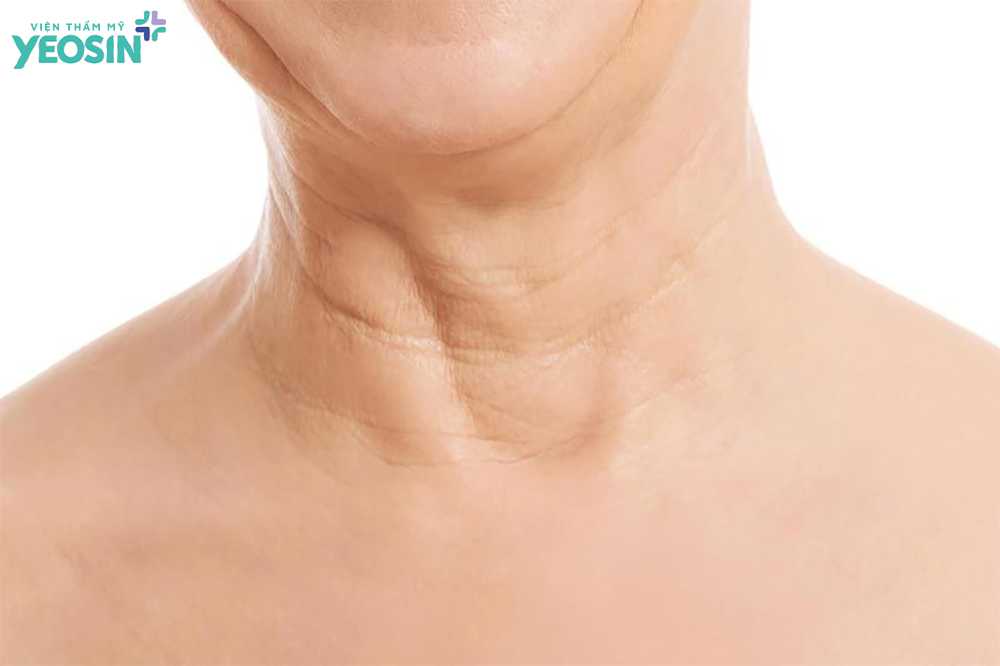 Nguyên nhân khiến da cổ bị nhăn, chùng nhão