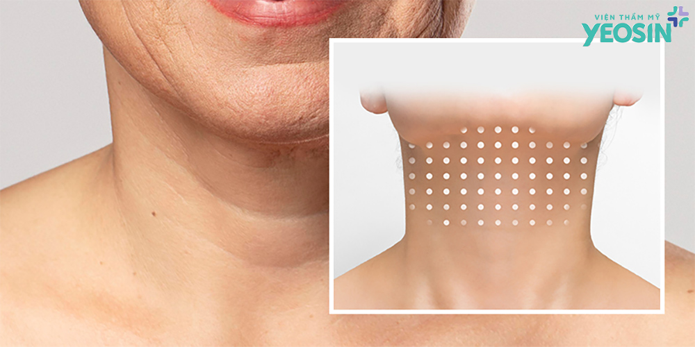 Cơ chế hoạt động của căng da cổ tại Viện Thẩm Mỹ Yeosin