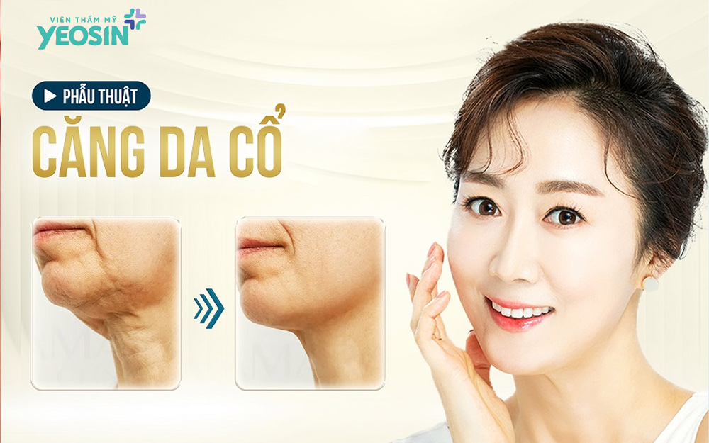 Hiệu quả nhận được sau khi căng da cổ