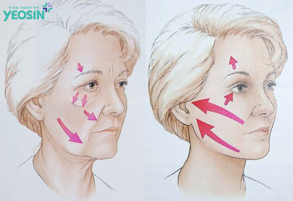 Hiệu quả nhận được sau khi căng da mặt Smas