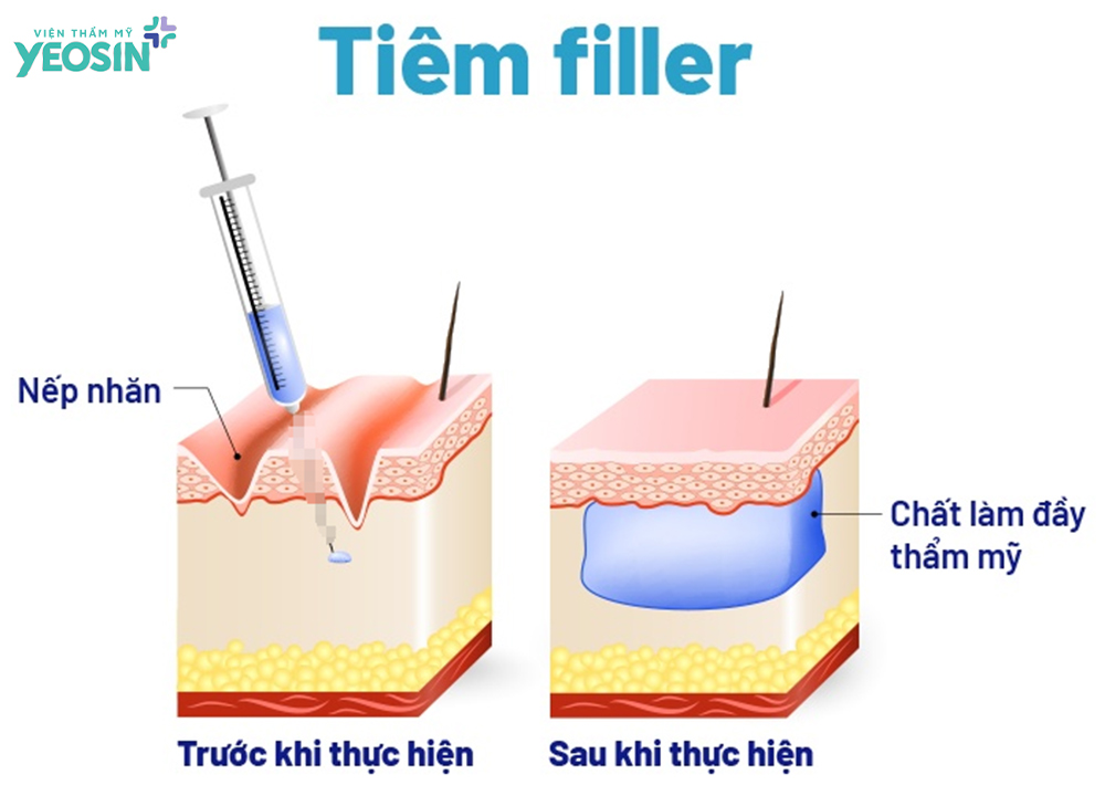 filler trẻ hóa làm đầy môi lớn
