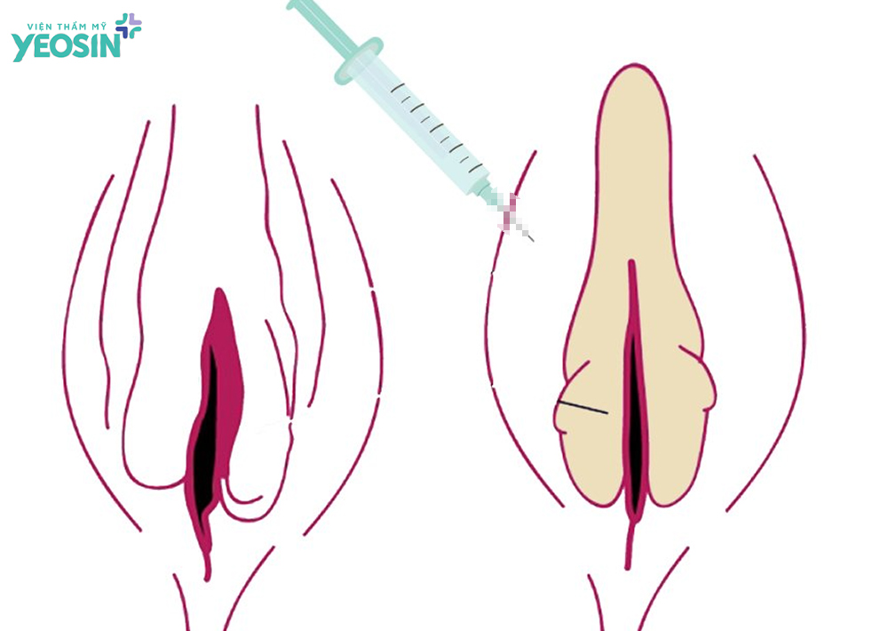 Hiệu quả nhận được sau khi filler làm đầy môi lớn