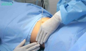 Quy trình hút mỡ 360 độ tại Viện Thẩm Mỹ Yeosin