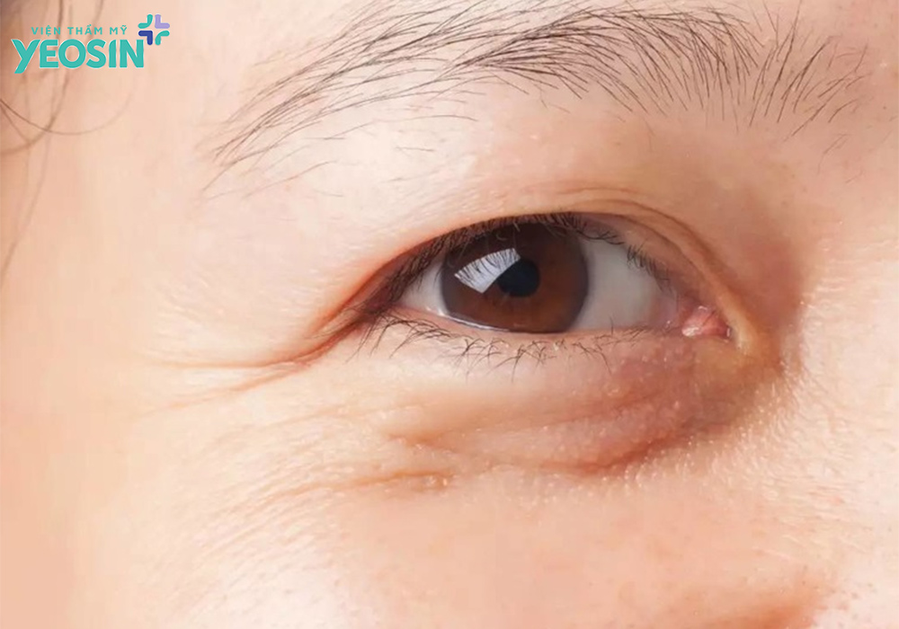 Nguyên nhân gây ra tình trạng sụp mí mắt, bọng mắt