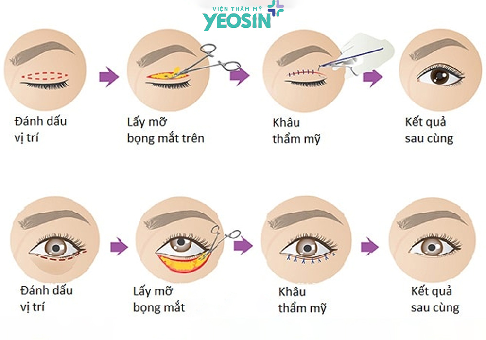 Cơ chế hoạt động của lấy mỡ thừa mí mắt, bọng mắt.