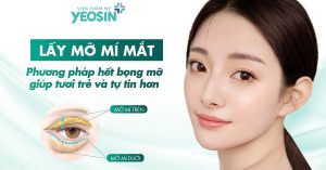 Lấy mỡ thừa mí mắt trên dưới