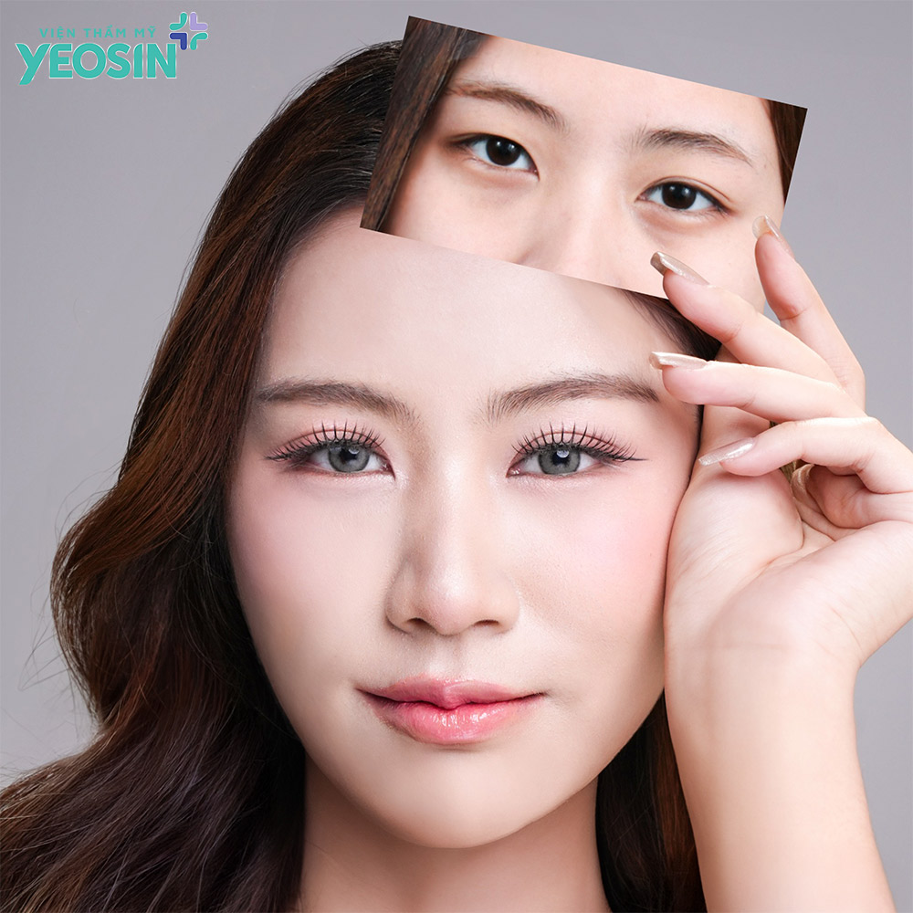 Hiệu quả nhận được sau khi lấy mỡ mắt