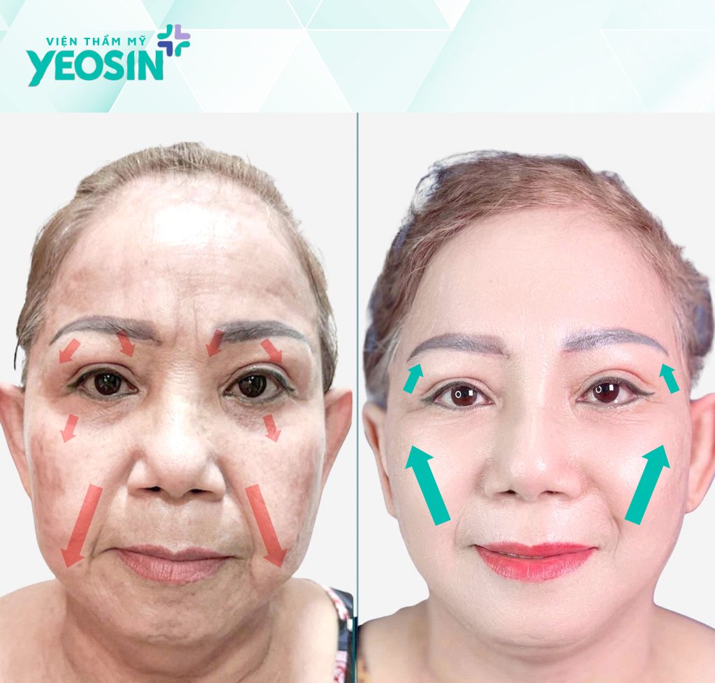 Hiệu quả nhận được sau khi căng da mặt Smas