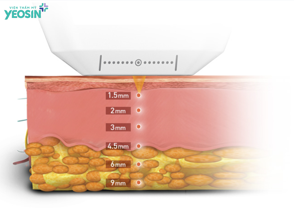 Nâng cơ trẻ hóa Hifu Doublo 2025 - Chìa khóa giữ mãi nét xuân 8 Cơ chế hoạt động của công nghệ nâng cơ trẻ hóa da Hifu Doublo